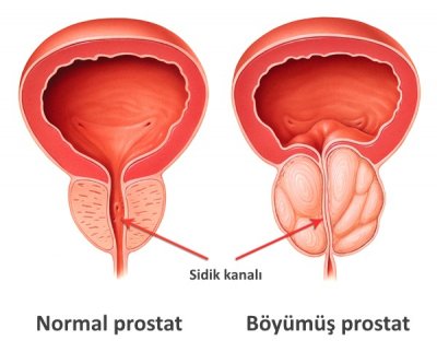 PROSTAT VƏZ XƏSTƏLİKLƏRİ HANSILARDIR